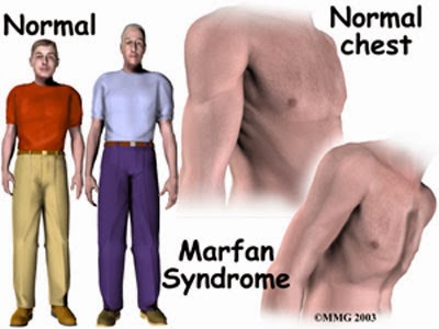 Marfan Syndrome Chest