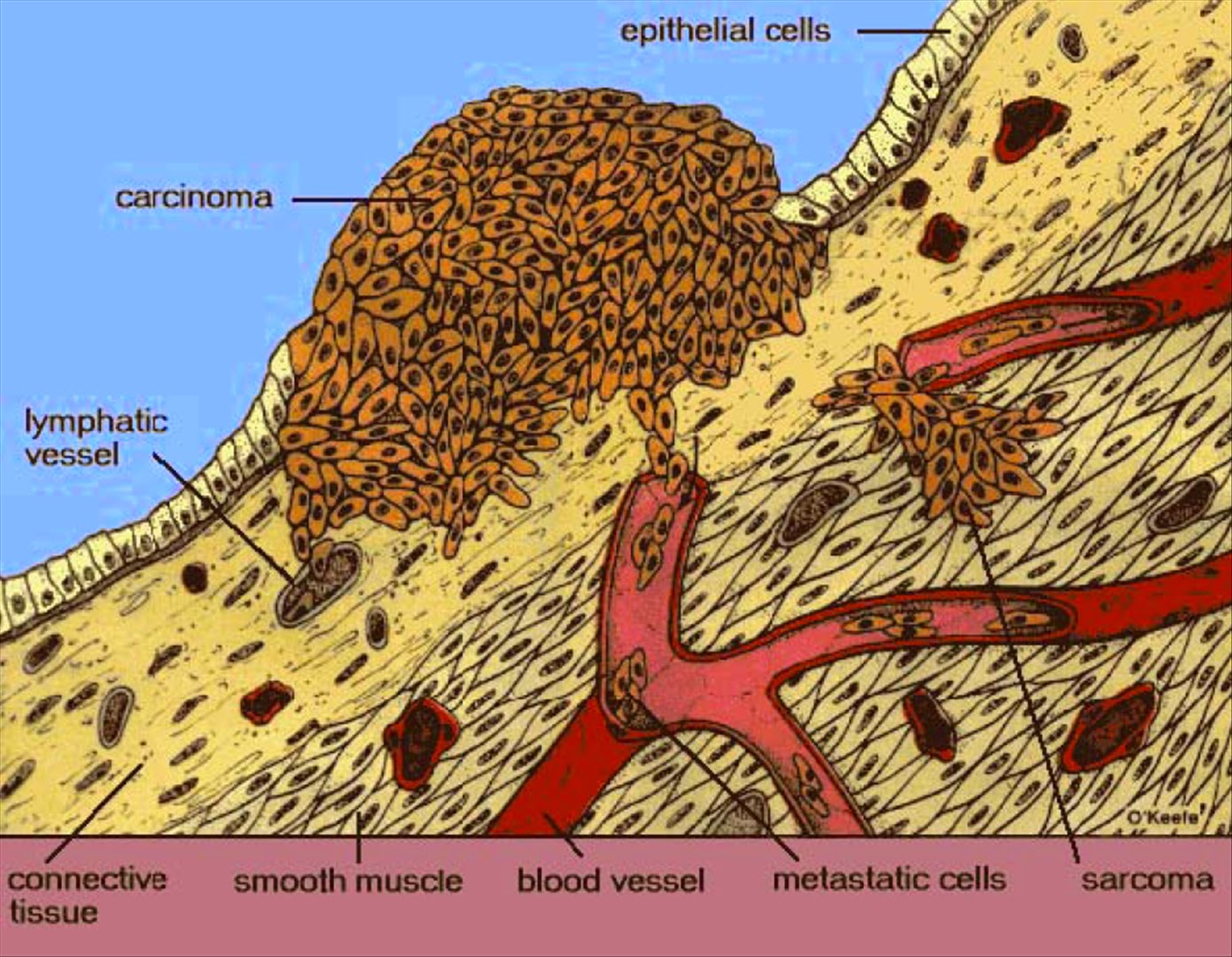 Распад кожи. Опухоли эпителиального происхождения. Клеточные структуры опухоли. Превращение клетки в опухолевую.