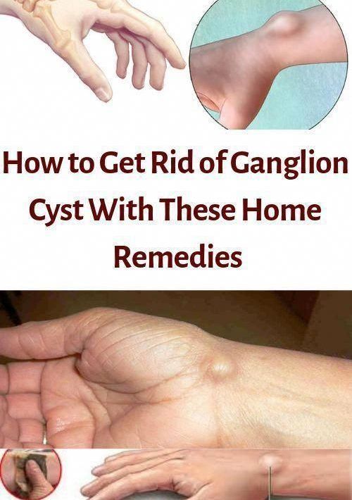 How to get rid of ganglion cysts with this home remedies? Healthy