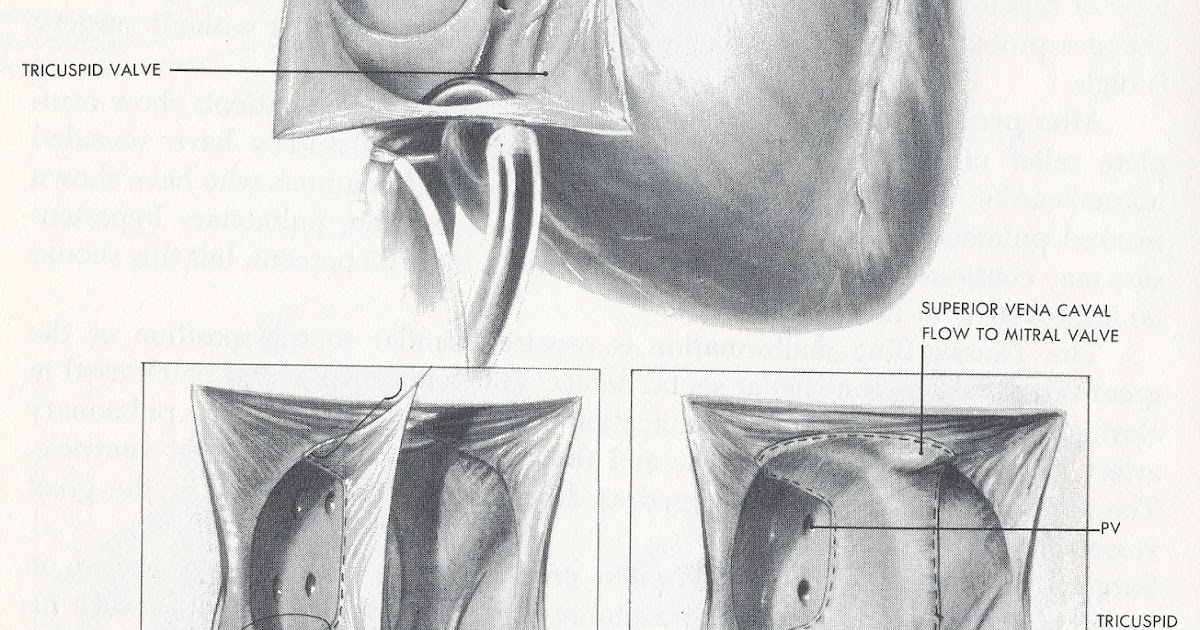 Pedi cardiology Mustard Operation for dTransposition of Great Arteries