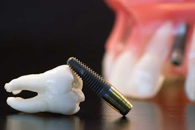 Trồng răng implant khi mất nhiều răng