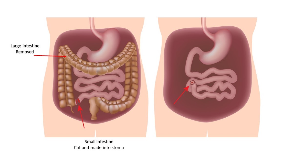 No More UC for Me JPouch Surgery 101