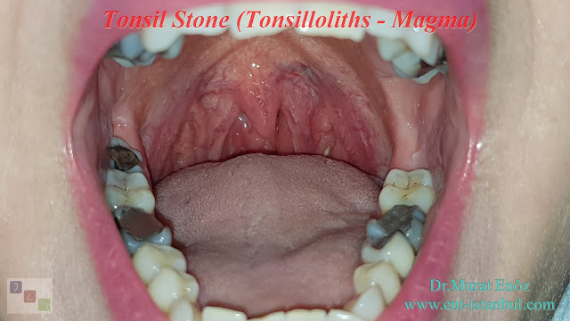 Tonsil Stone (Tonsilloliths - Magma) - Definition, Symptoms and Treatment