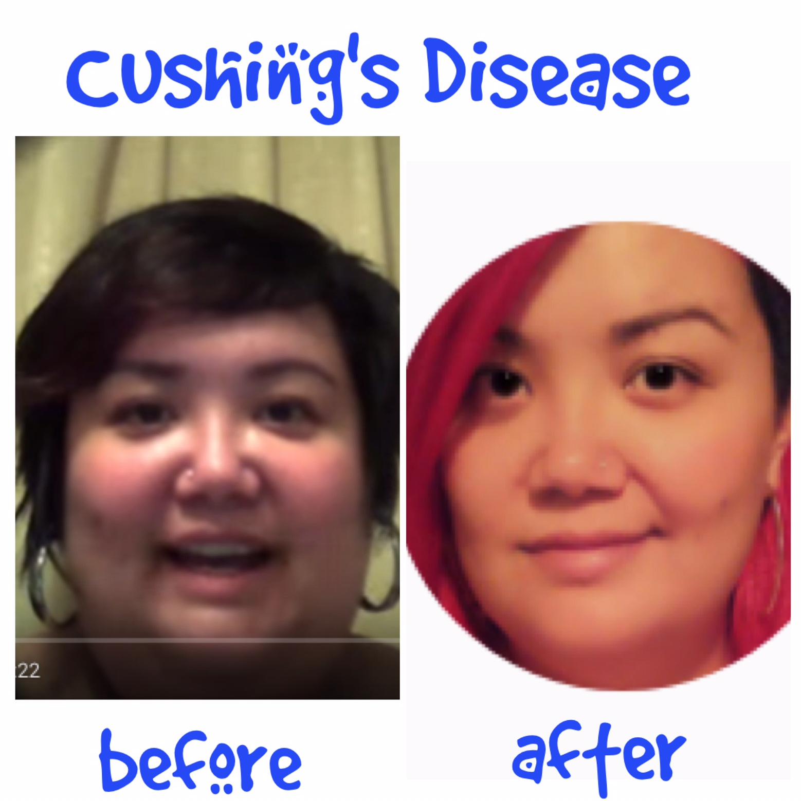 Top 105+ Pictures Cushing's Syndrome Cushing's Disease Before And After