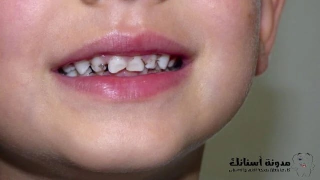 3ilaj taswos asnnan al atfel bisor3a هل علاج تسوس الأسنان اللبنية ضروري؟