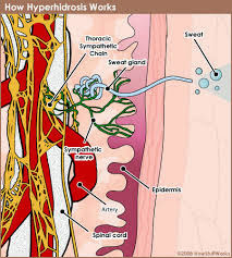 Ιδρώνετε υπερβολικά; Ποιες παθολογικές καταστάσεις προκαλούν υπεριδρωσία; 4