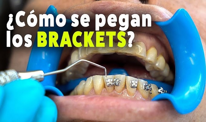 ORTODONCIA: ¿Cómo se pegan los brackets al diente? - Dr. Ricardo González