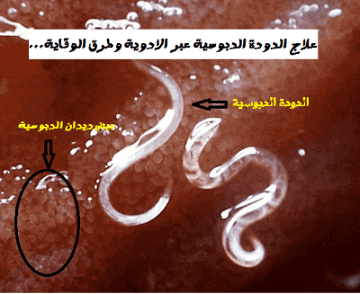 علاج الدودة الدبوسية عبر الادوية وطرق الوقاية من الديدان الدبوسية مدونة عجائب الصحة