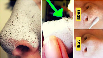 How To Get Rid Of Blackheads And Whiteheads Overnight.