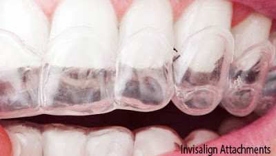 Why Is Invisalign Attachments So Famous?