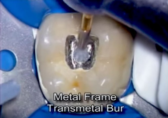 ACCESS CAVITY: Tooth with Metal ceramic crown