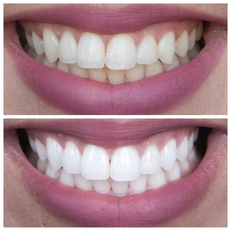 Teeth Whitening For A Flawless Smile, Remember Montreal International