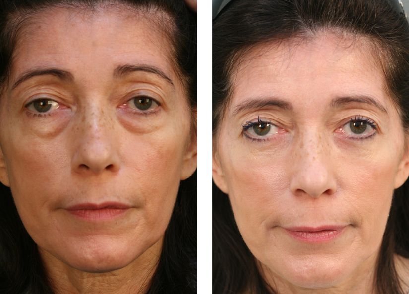 Facelift Toning Workouts To Renew Your Neck And Face Reducing Eye Bags
