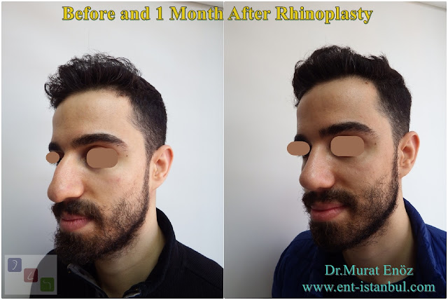 Rhinoplasty For Men Istanbul,crooked nose job,Asymmetric nose operation,Micro-Motor Assisted Rhinoplasty Operation Istanbul,Twisted Nose Aesthetic,