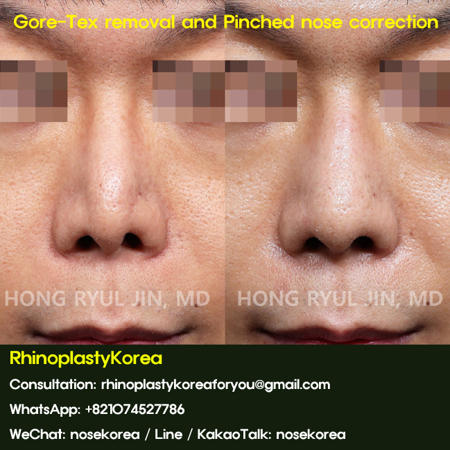 GoreTex removal and pinched nose corection.