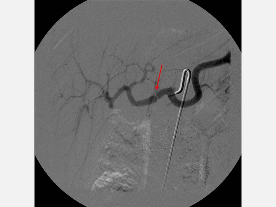 The Pump and the Tubes Hepatic Artery Complications Following Liver Transplant