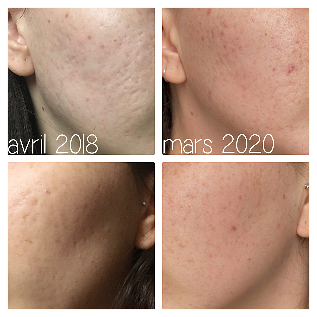 Le laser CO2 2 ans après, quels sont les résultats ? Queenmercury Lifestyle and more ! Le laser CO2 2 ans après, quels sont les résultats ? Queenmercury Lifestyle and more !