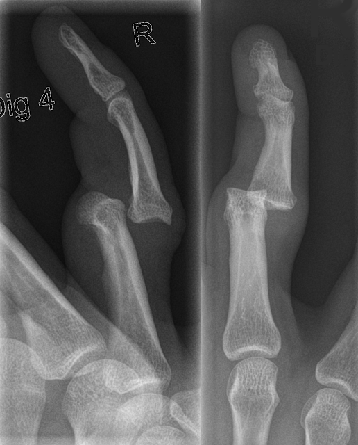 Knuckle Fracture Treatment Knuckle Bone Fracture Surgery