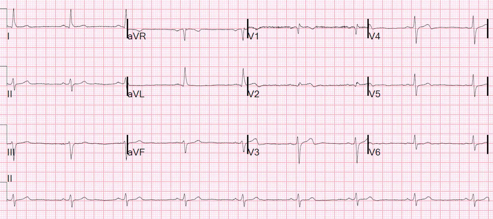 Dr. Smith's ECG Blog 2 Cases of Resolved Chest Pain with Dynamic