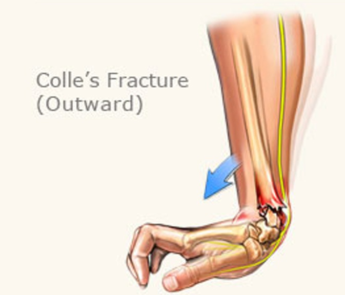 colles fracture smith fracture colles fracture smith fracture