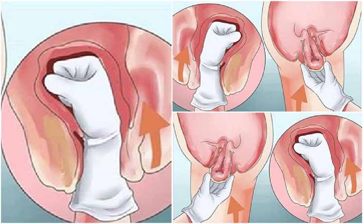 Penting Untuk Wanita, Inilah Gejala dan Tanda Awal Peranakan Turun Turun%2BPeranakan