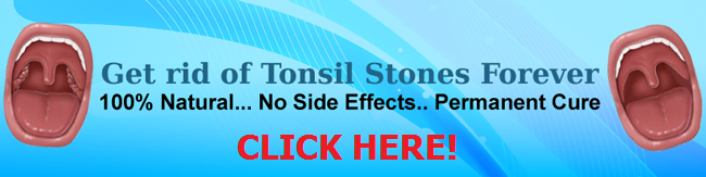 Cure Tonsil Stones
