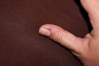 chewed up thumb