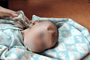 Dianiaya Ibu Kandung Hingga Kepala Benyok, Bayi Berusia 4 Bulan Dirujuk Ke RSU Sipirok Tapanuli Selatan