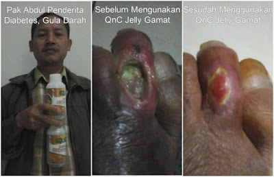 Biaya Operasi Keloid Saat Ini Biaya Operasi Keloid Saat Ini
