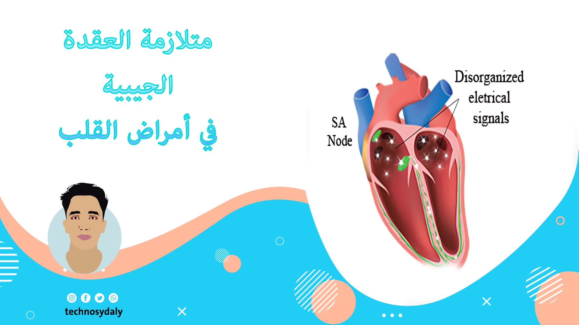 متلازمة العقدة الجيبية في أمراض القلب متلازمة العقدة الجيبية في أمراض القلب