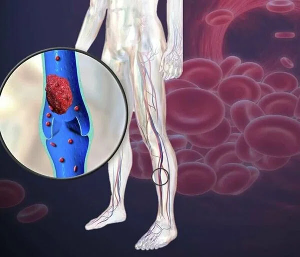 La thrombose, une maladie silencieuse qui peut être fatale