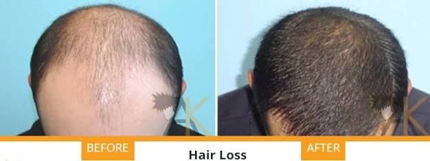 Be Positive Hair Fall Control