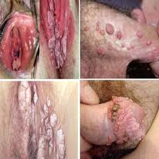 bintik kasar pada bibir vagina