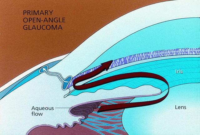 Open Angle Glaucoma