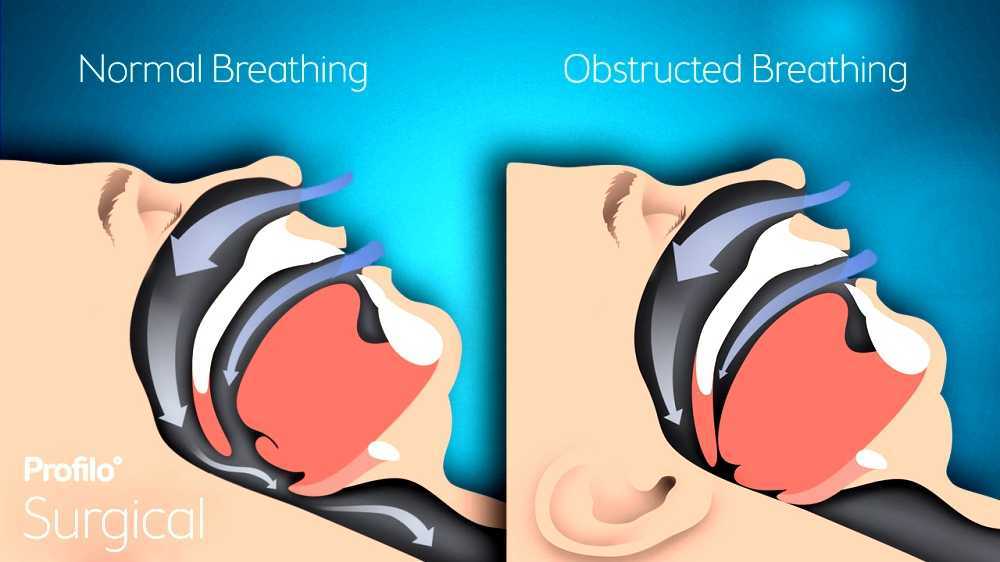 Obstructive sleep apnea