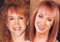 Kathy Griffin Plastic Surgery.