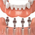 Ưu và nhược điểm của phương pháp trồng răng implant