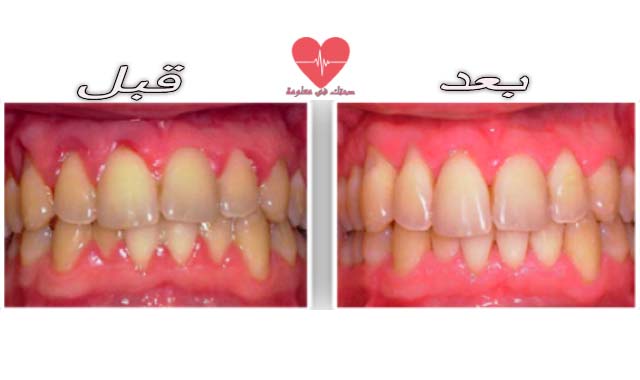 علاج التهاب اللثة وتورمها في المنزل علاج التهاب اللثة