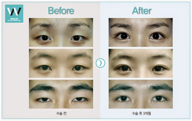 почему двойное веко. операция на двойное веко в корее. эпикантус и двойное веко. почему двойное веко. Bts тэхен второе веко.