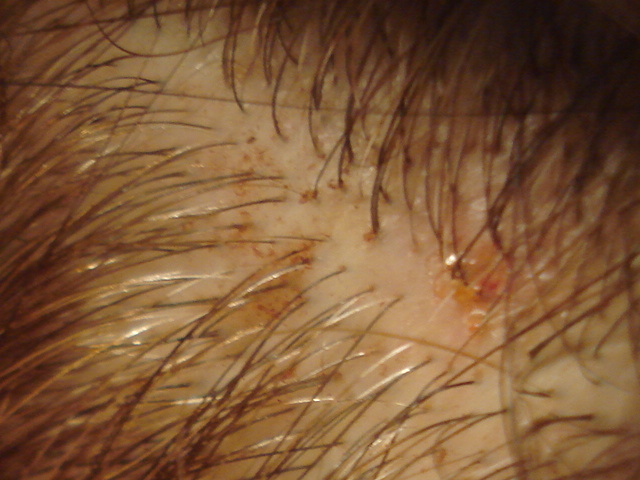 Pityriasis Hardened Sebum On Scalp : Hyperseborrhea : Tartar makes plaque more difficult to remove and creates a shield for.