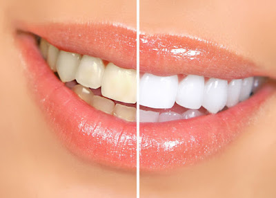 Tẩy trắng răng giữ được bao lâu thì xỉn màu? 1