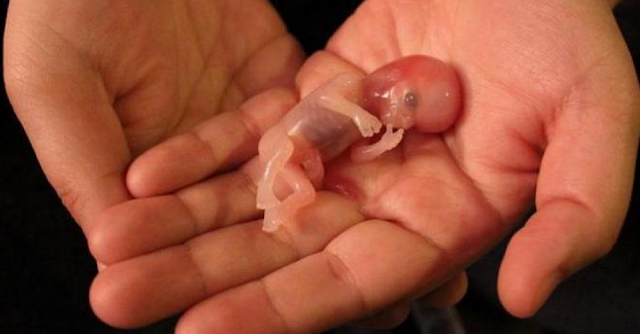 Belajar dari Kasus Istri Opick, Kenali Gejala dan Penyebab Keguguran yang Kerap Terjadi Belajar dari Kasus Istri Opick, Kenali Gejala dan Penyebab Keguguran yang Kerap Terjadi