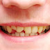 Vì sao cần bọc răng sứ khi bị sâu răng?