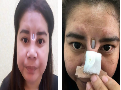 Nose Job Gone Wrong Leaves Lady With Implant Poking Through Her Skin A case presented to the southwark coroner's court heard that doctors continued operating on kelly mclure, 31, after she suffered her cardiac arrest at the private belvedere hospital, in kent. empressive naija