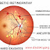 Diabetic Retinopathy | Doctors Gang Opthalmology