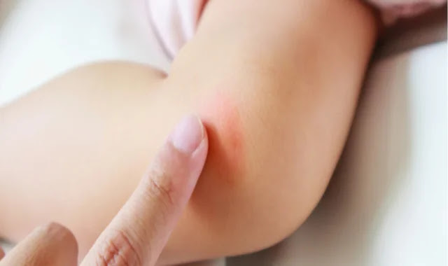 Removing traces of wounds in children