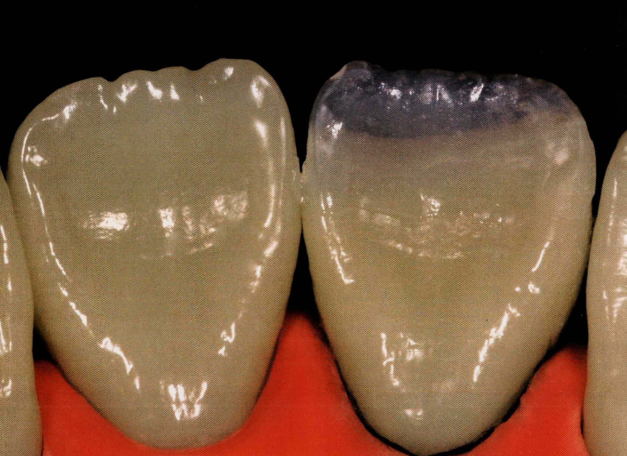 Class IV composite " silicone guide technique " Dental Esthetics