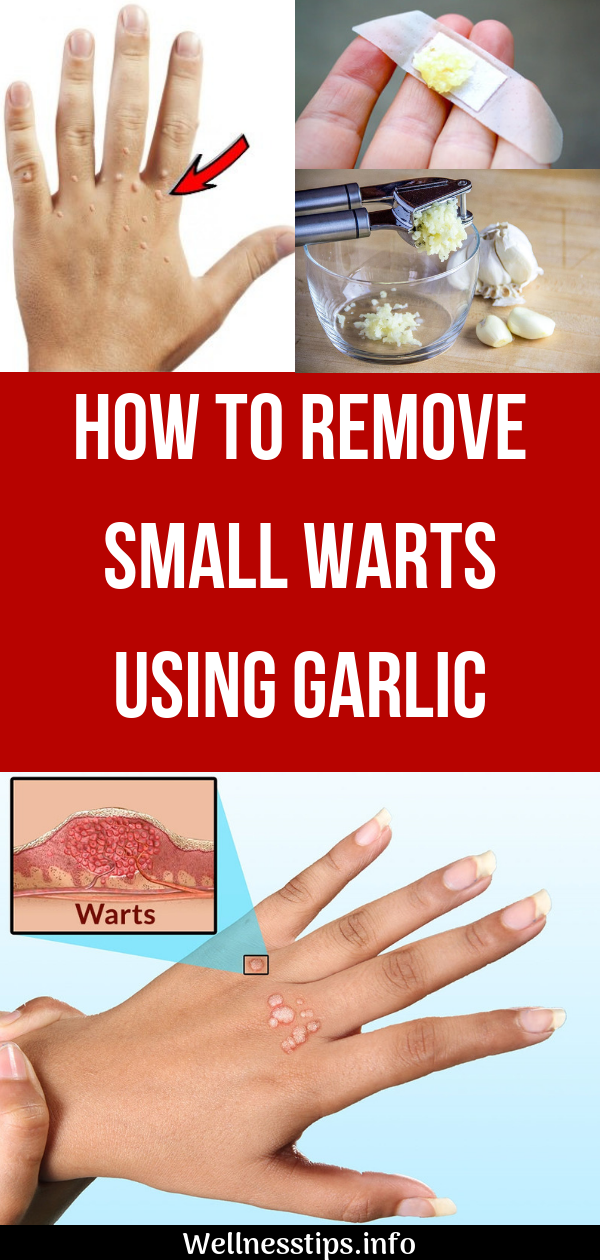 How To Remove Small Warts Using Garlic master beauty pin 2