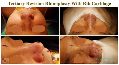 Rhinoplasty In Istanbul,Tertiary Revision Rhinoplasty,revision rhinoplasty,Revision Rhinoplasty With Rib Cartilage,