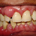 Chữa sưng mộng răng an toàn tại nha khoa